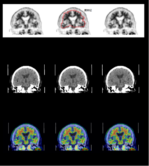 康瑞医学丨大脑里的 “隐形警报”：这项神奇检查如何揪出阿尔茨海默病？​
